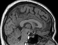 Structural MR Image of a brain